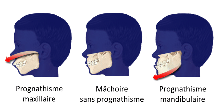 Qu’est-ce-que la prognathie ? 