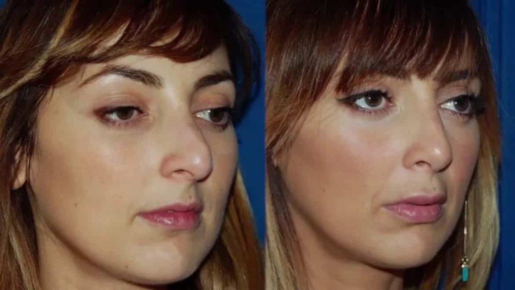 3 choses à savoir sur la rhinoplastie présentée lors du congrès de 2018 à Lyon